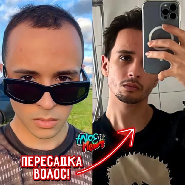 Пересадка волос Слава Марлоу. Статья от ГорМедЦентра
