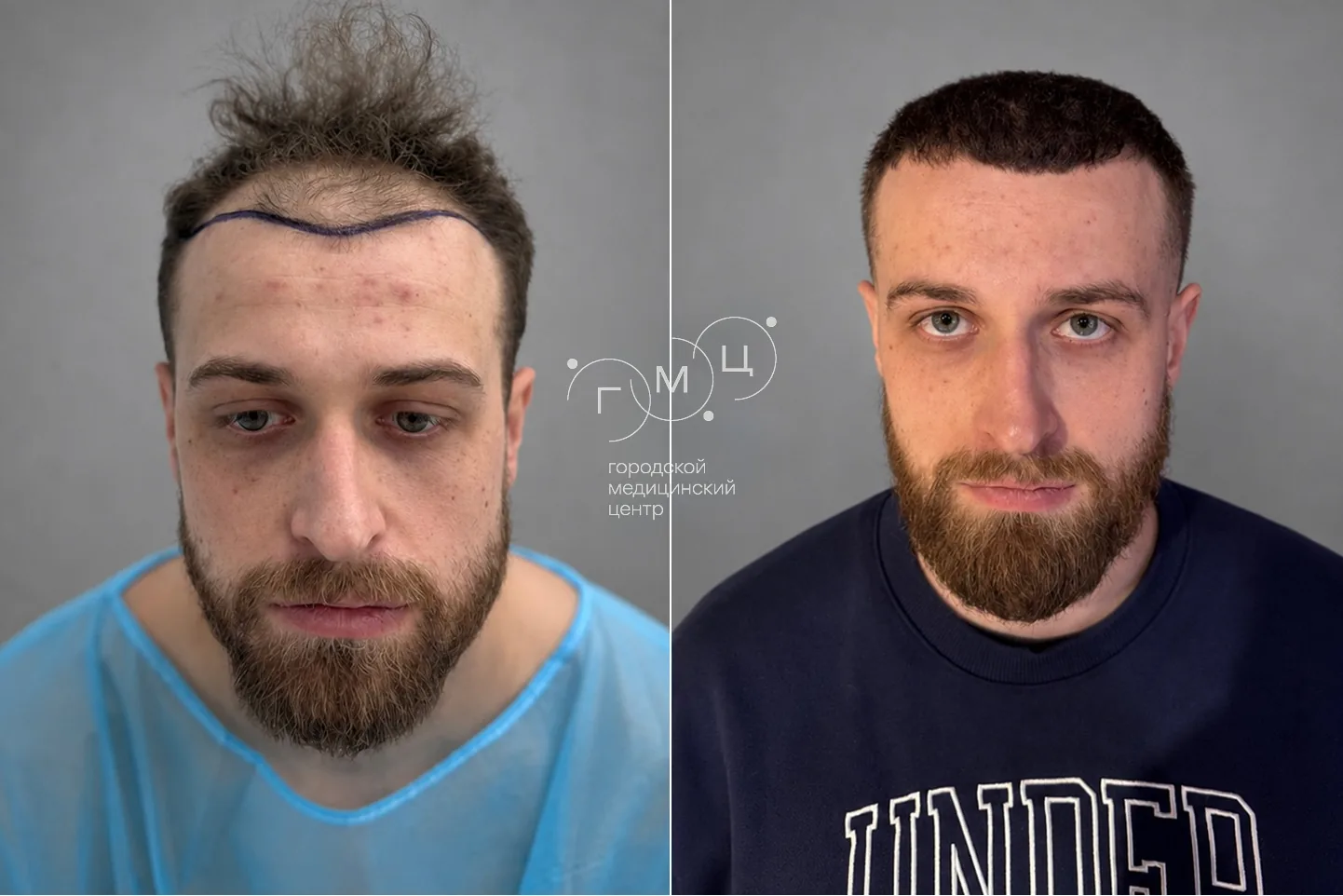 Пересадка волос на голове: фото до и через 12 месяцев, 2800 графтов, метод FUE