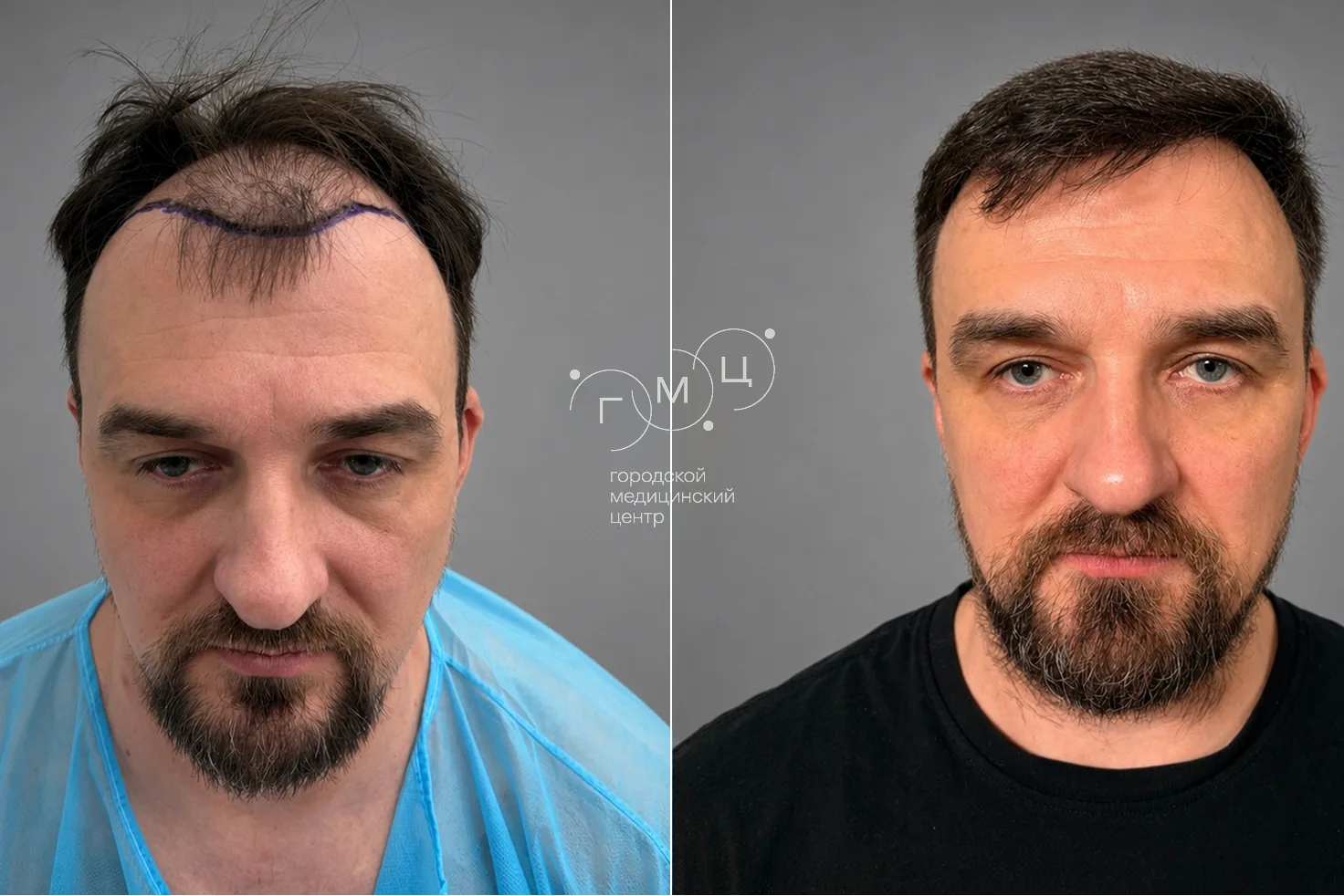 Пересадка волос на голове: фото до и через 12 месяцев, 2700 графтов, метод FUE