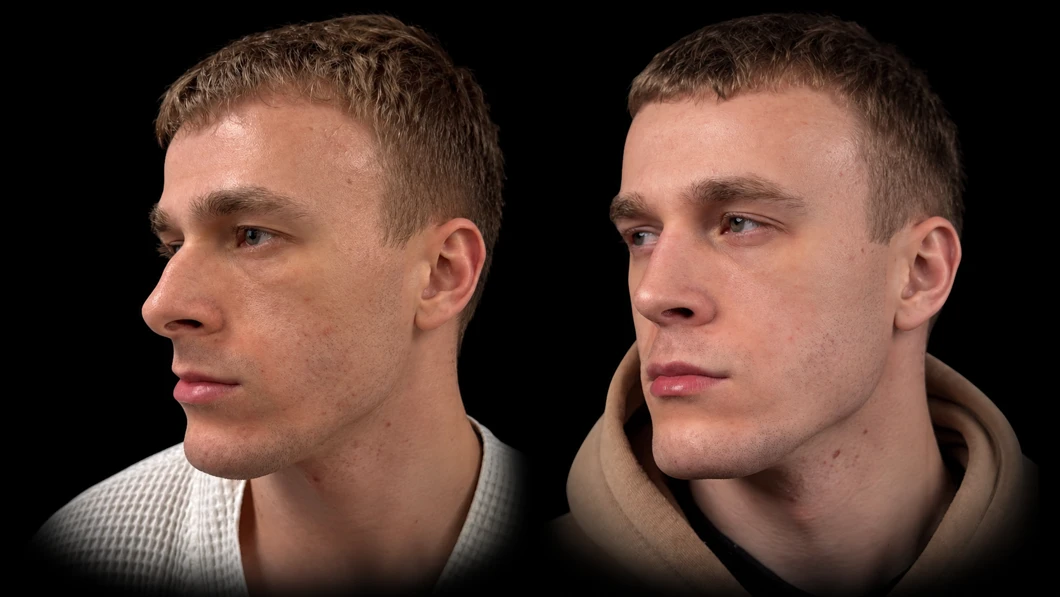 Пациент до и после риносептопластики