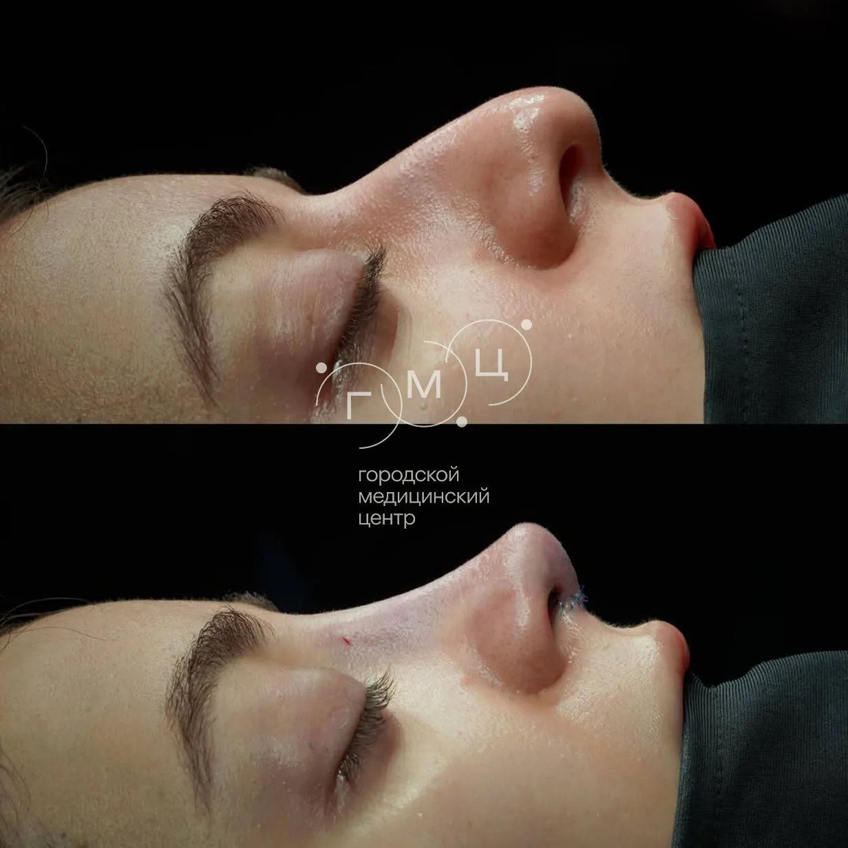 Ринопластика: форма носа до операции и сразу после неё