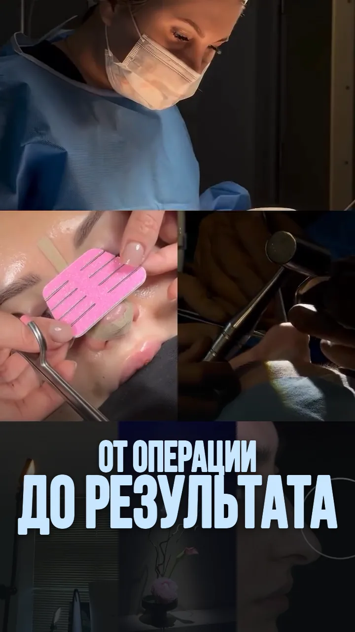 Хирург во время ринопластики, лонгета и профиль после операции