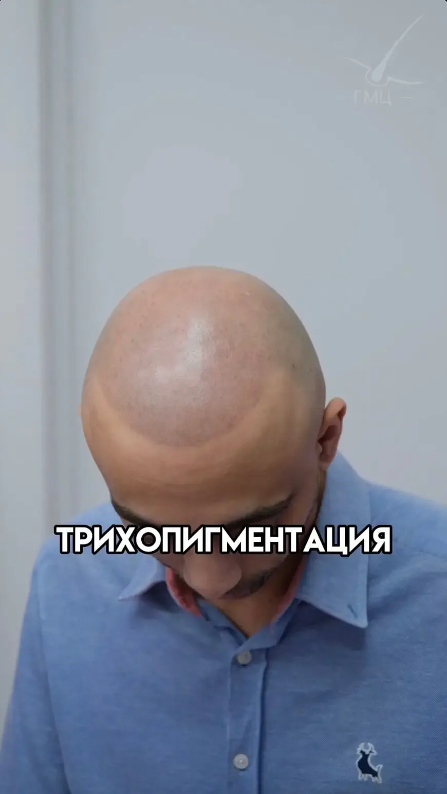 Трихопигментация